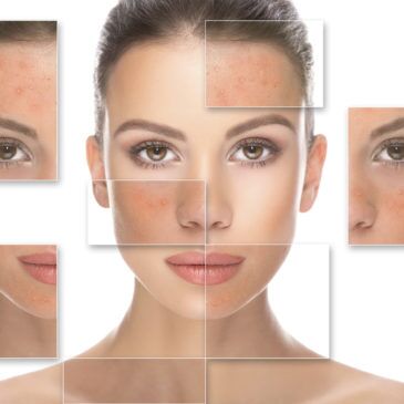 lactic acid peel works on acne and wrinkles
